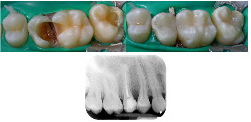 La Devitalizzazione Del Dente Indicazioni Tecniche E Costi Dentista Resta