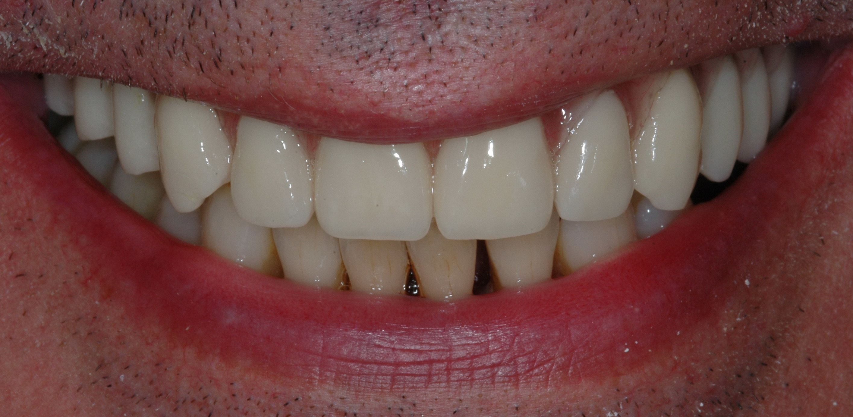 Dentiera Mobile Senza Palato Video Dentiera fissa senza palato – Cura della pelle