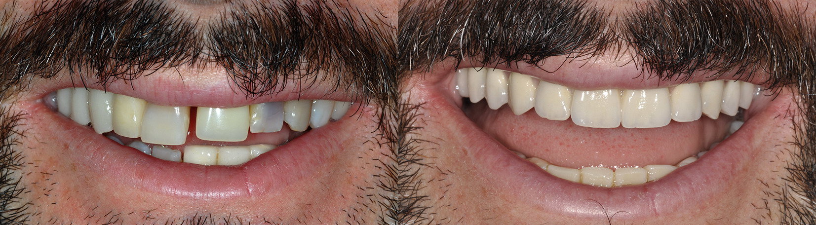 implantologia all on 4