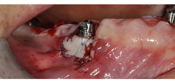 Implantologia dentaria
