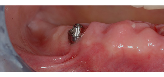 implantologia dentale è dolorosa