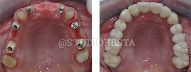 corone dentali in zirconio bari