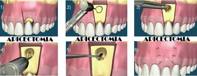 APICECTOMIA