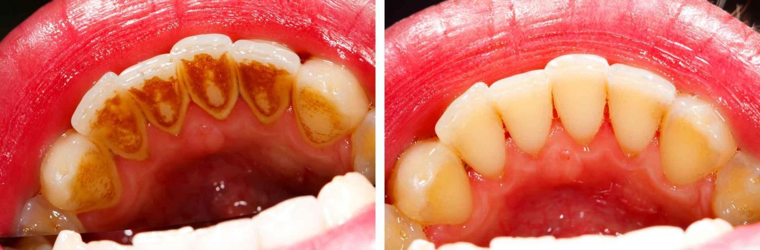 PULIZIA DEI DENTI professionaleCos'è? Fa male?Quanto dura? Dentista Resta