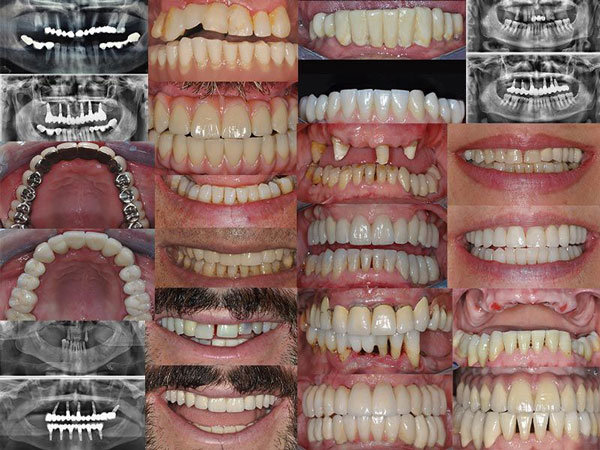 Impianti dentali foto prima e dopo