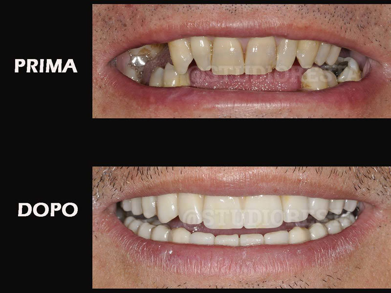 Impianti dentali foto prima e dopo