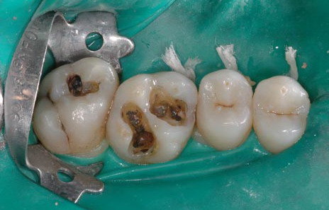Carie denti sintomi