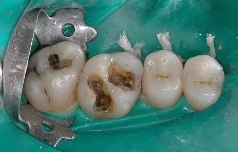 Kit 3 Strumenti Dentali Per Rimozione Corona E Ponte | Acciaio Inox | MEDSPO Restauro Dentale - Foto 4