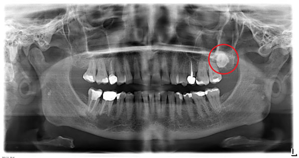 ascesso denti