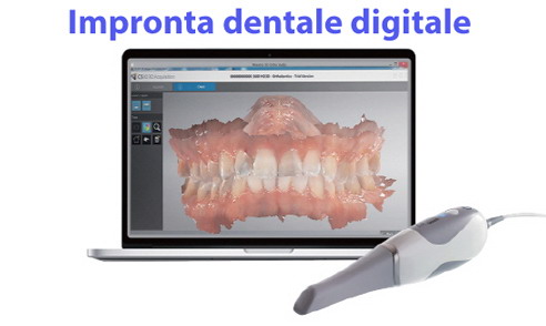 Impronta dentale digitale