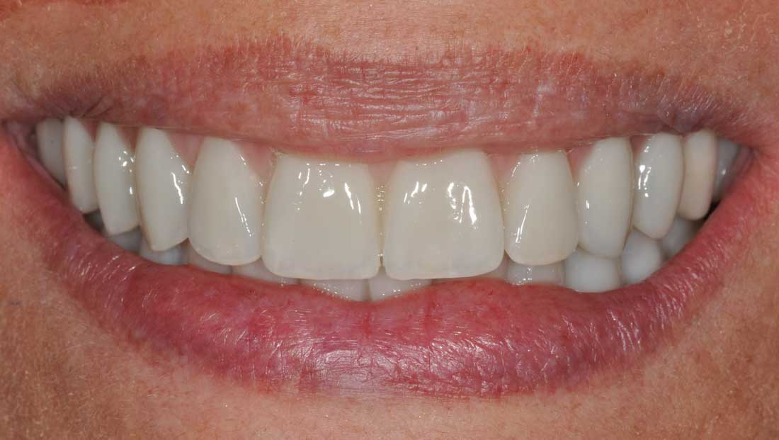 Caso Top copertina landing implantologia Caso Top copertina landing implantologia