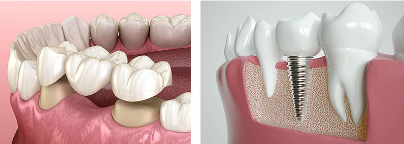 Protesi fissa su impianto dentale